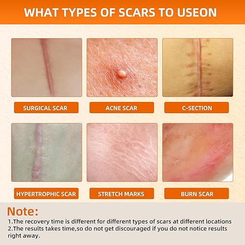 Miniatura 4 de Hojas de silicona para cicatrices (rollo de 1.6 x 79 pulgadas, 6.6 ft), tiras de silicona reutilizables para cicatrices, cintas de silicona suave