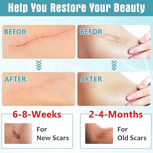 Miniatura 5 de Hojas de silicona para cicatrices (rollo de 1.6 x 197 pulgadas, 16.4 ft), cinta de silicona profesional para cicatrices, aptas para cicatrices