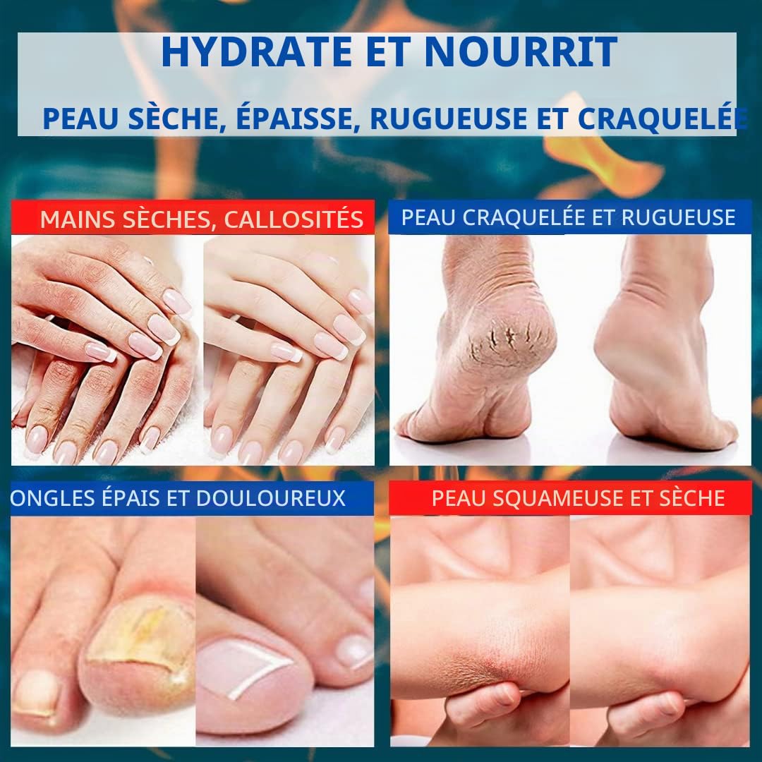 Crème D'Urée 30% - Élimine Les Cicatrices, L'Eczéma, La Kératose, Le Psoriasis, Éruptions Cutanées Pour Peaux Sèches Et Craquelées, Cutanées, Aide À Éliminer Cicatrices Cicatrisation Des Plaies Avec De L'Acide Lactique Aha, Écorce Chêne Huile Germe Blé ,
