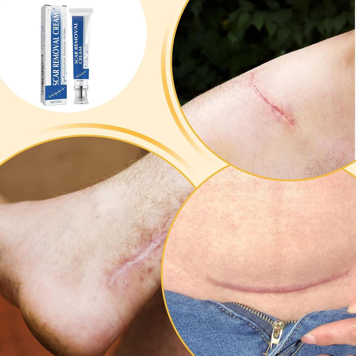 Crema per cicatrici, unguento per la rimozione delle smagliature, ammorbidisce la pelle ruvida, schiarisce ustioni e cicatrici post-operatorie, per la routine quotidiana di ginocchia, ustioni