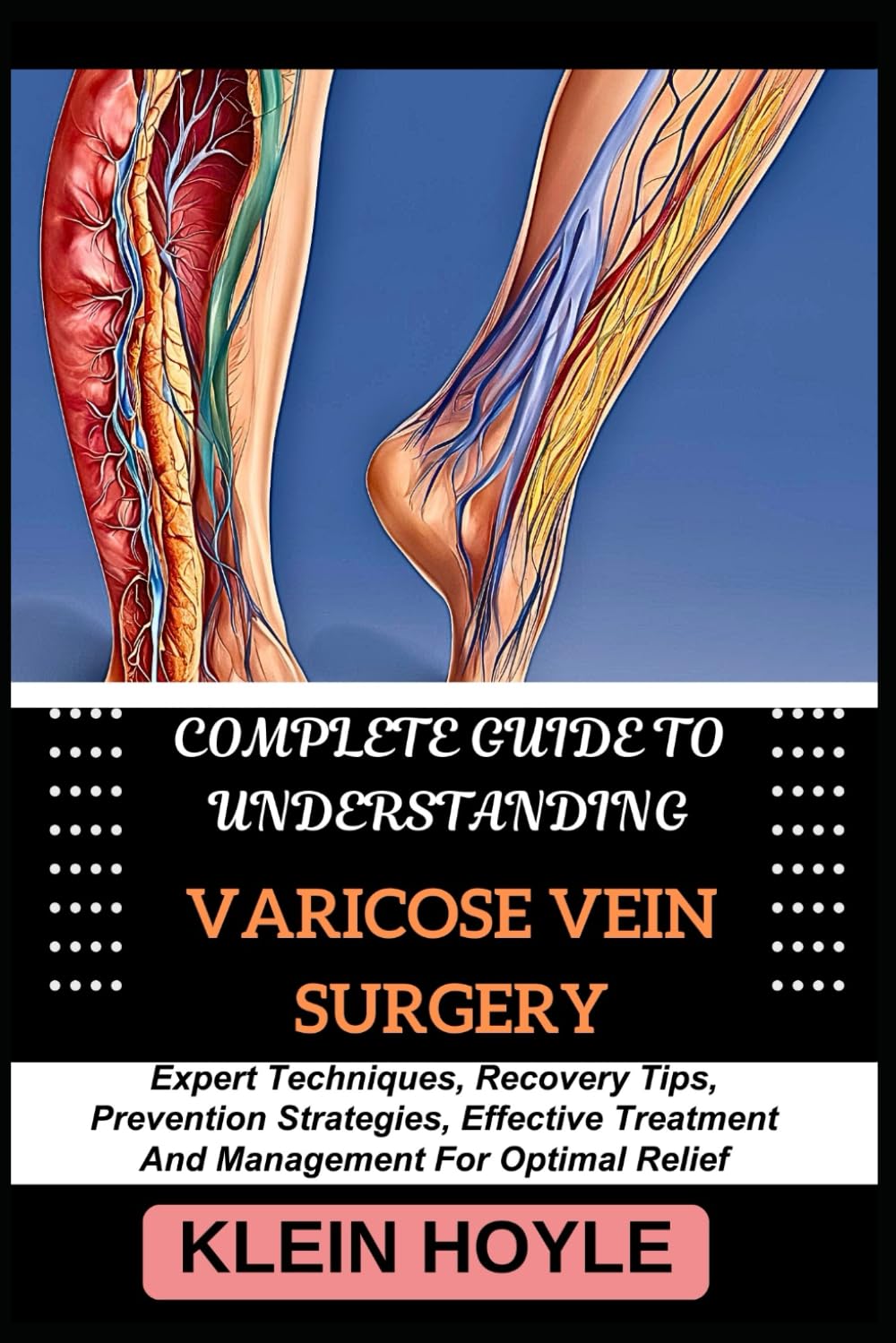 COMPLETE GUIDE TO UNDERSTANDING VARICOSE VEIN SURGERY: Expert Techniques, Recovery Tips, Prevention Strategies, Effective Treatment And Management For Optimal Relief