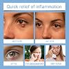 2 Pcs Chalazion & Blepharitis Treatment Eye Cream, Chalazion Eye Treatment Cream, Eye Creams for Dry Eyelids, Eye Cream for Dark Circles And Puffy Eye Bags & Puffiness, Stye Eye for All Skin Types