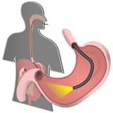 endoscopy procedure Endoscopy is a nonsurgical procedure used to examine a person's digestive tract.