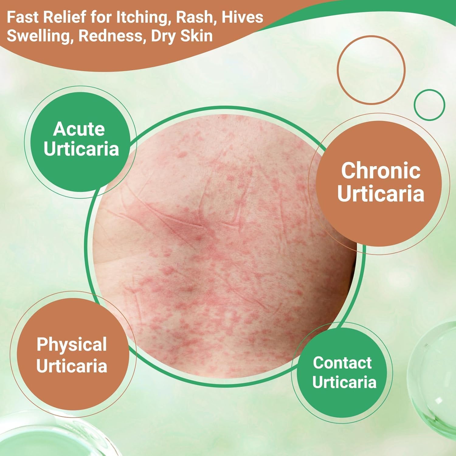 Urticaria Creme zur Linderung von Nesselsucht - Schnell wirkende Juckreizbehandlung bei Hautausschlägen, Rötungen, Pickeln & Ödemen | Fortschrittliche Formel