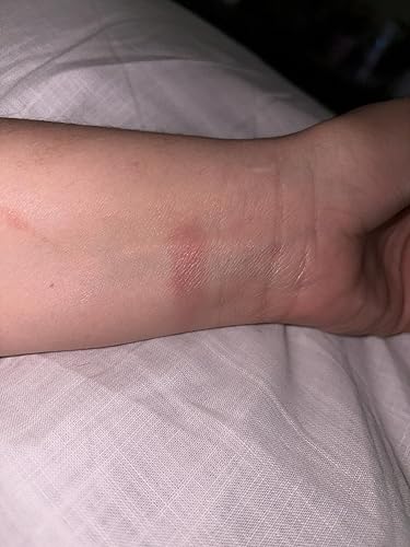 Burned wrist