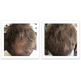 FEBRON Hair Fibers For Thinning Hair For Women & Men Hair Loss Concealer Hair Powder Volumizing Based 100% Undetectable & Natural - Bald Spots Filler (30 Gram, Light COOL Brown)