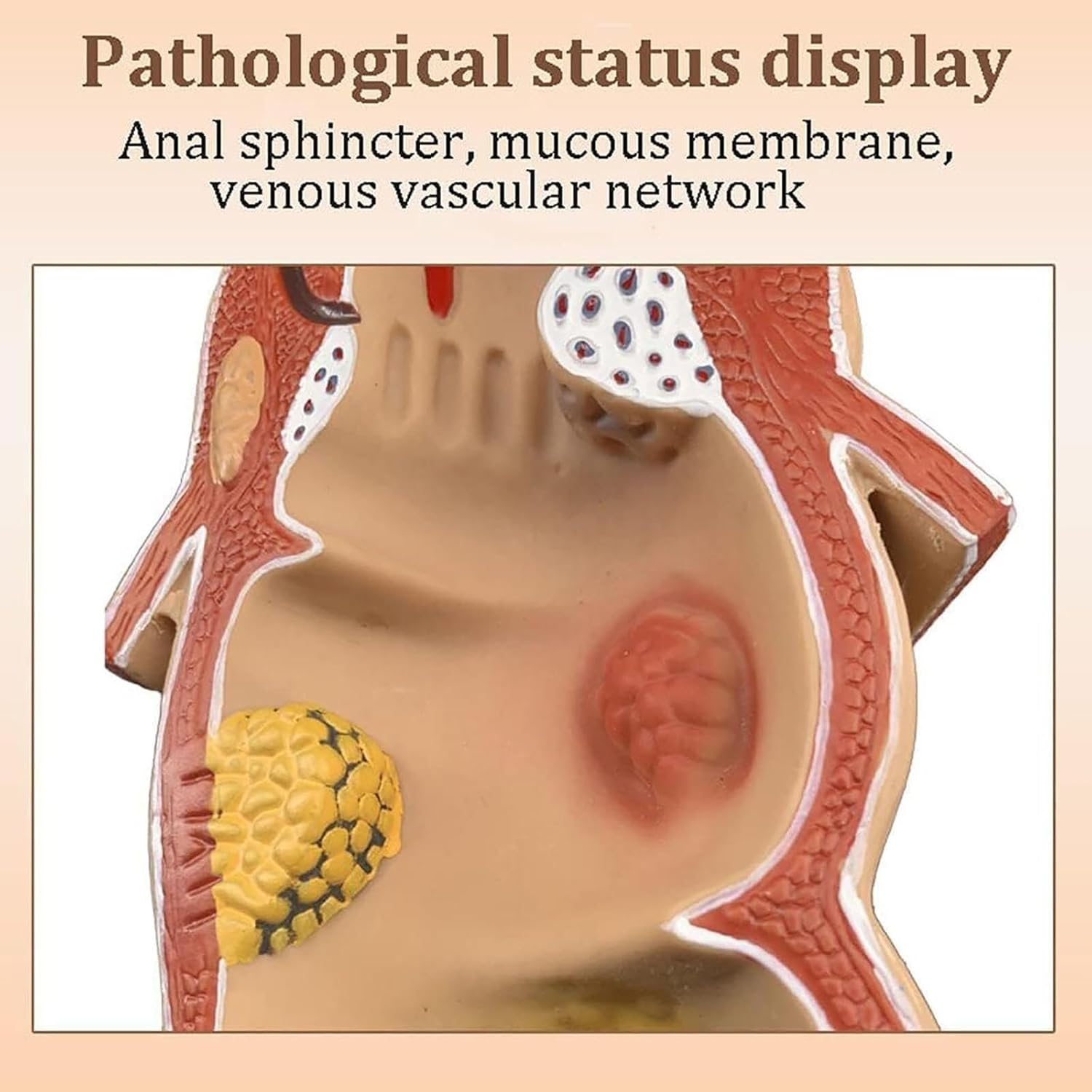 Rectal Ulcer Anatomical Model,Anatomical Human Rectum Pathology Lesion Model Hemorrhoids Anus Medical Teaching