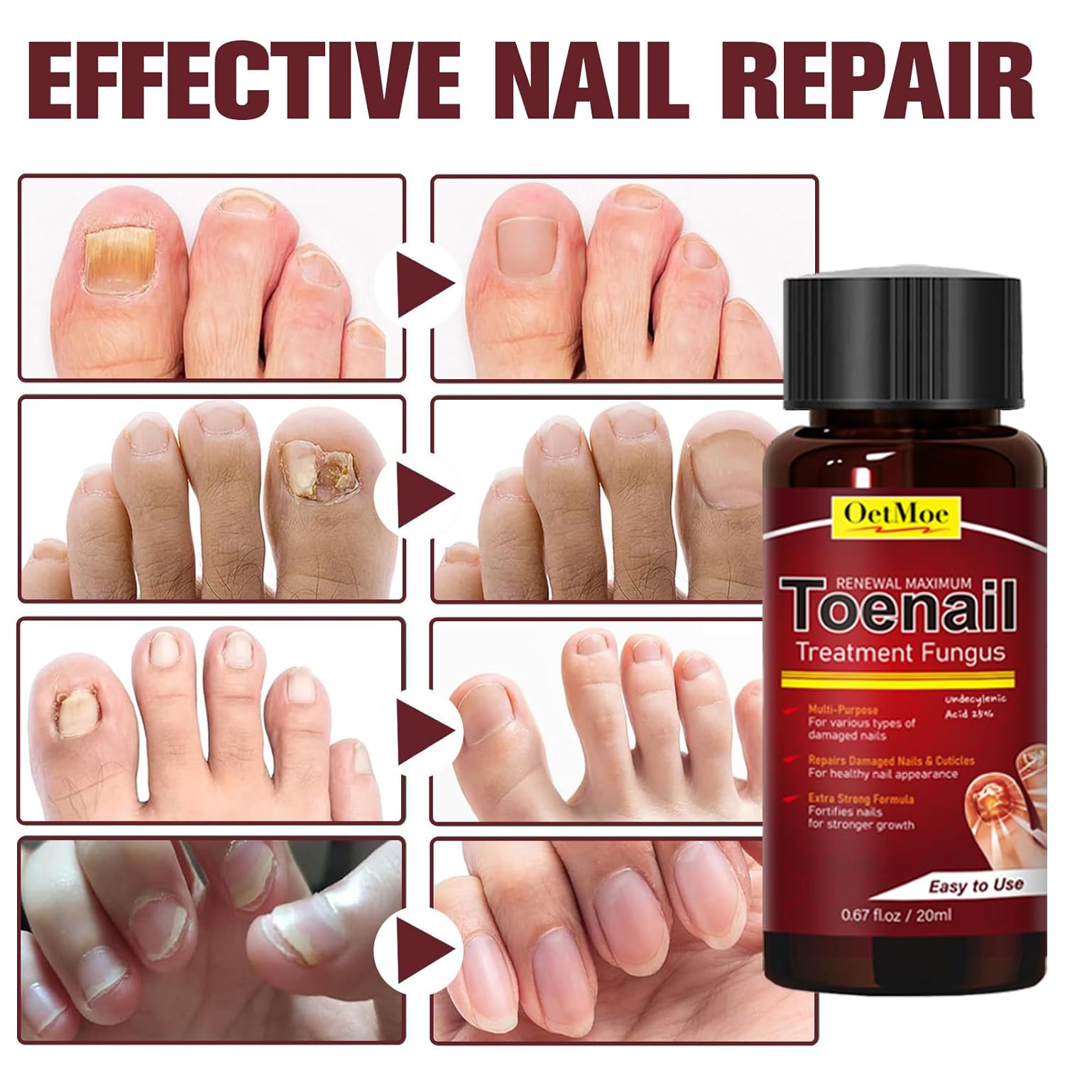 Toenail Fungus Treatment Extra Strength, Nail Fungus Treatment for Yellow, Thick, Discolored, Broken Nails, Ultimate Fungal Nail Repair, Make Nails Look Healthier Stronger, 2 Bottles - Image 4