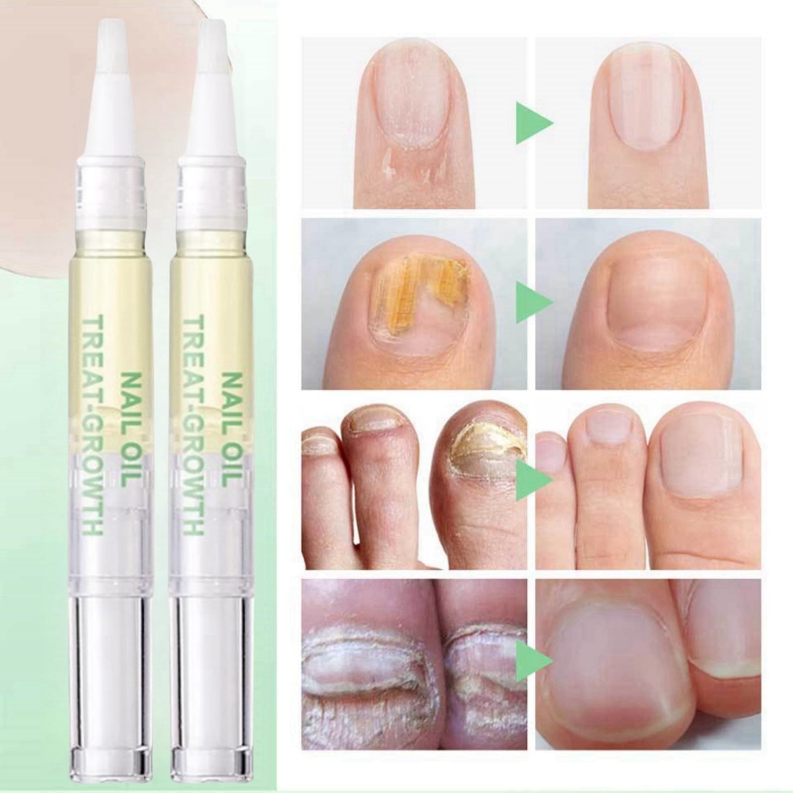 2pcs Radiant Nail Growth Oil,Radiant Nail Growth Oil Pen,Cuticle Oil Pen for Nails,Nail Growth Pen,Nail Growth Serum,Nail Strengthener Oil,Nail Nutrient Oil Pen,Cuticle Care Oils,Nail Nutrient Oil Pen - Image 2