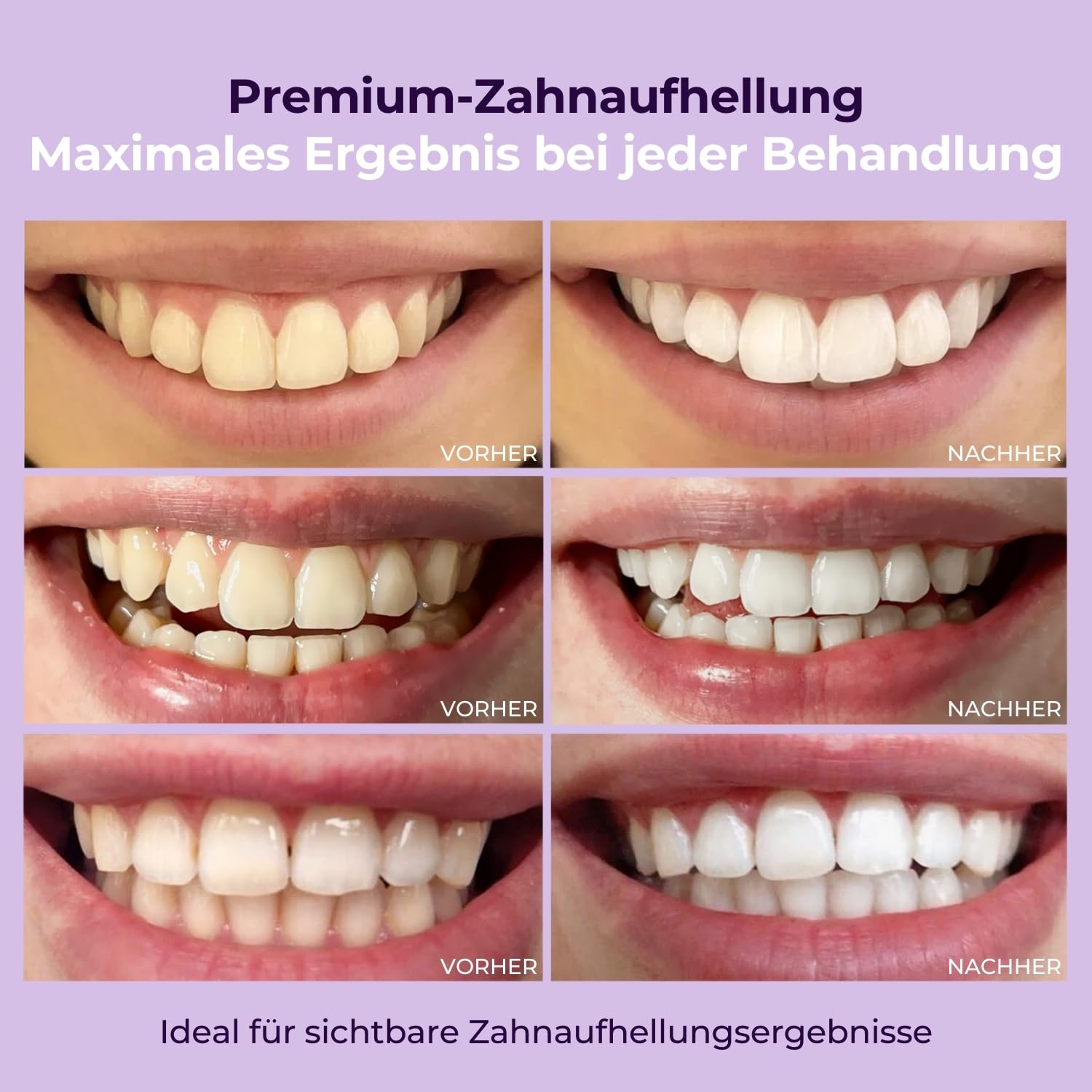 OnlySmile Confezione da 3 gel sbiancante per denti bianchi Vincitore del test 2024-2025 | 9+ sfumature in 5 giorni | Gel sbiancante vegano per sbiancamento dei denti | Sbiancamento dei denti a casa |