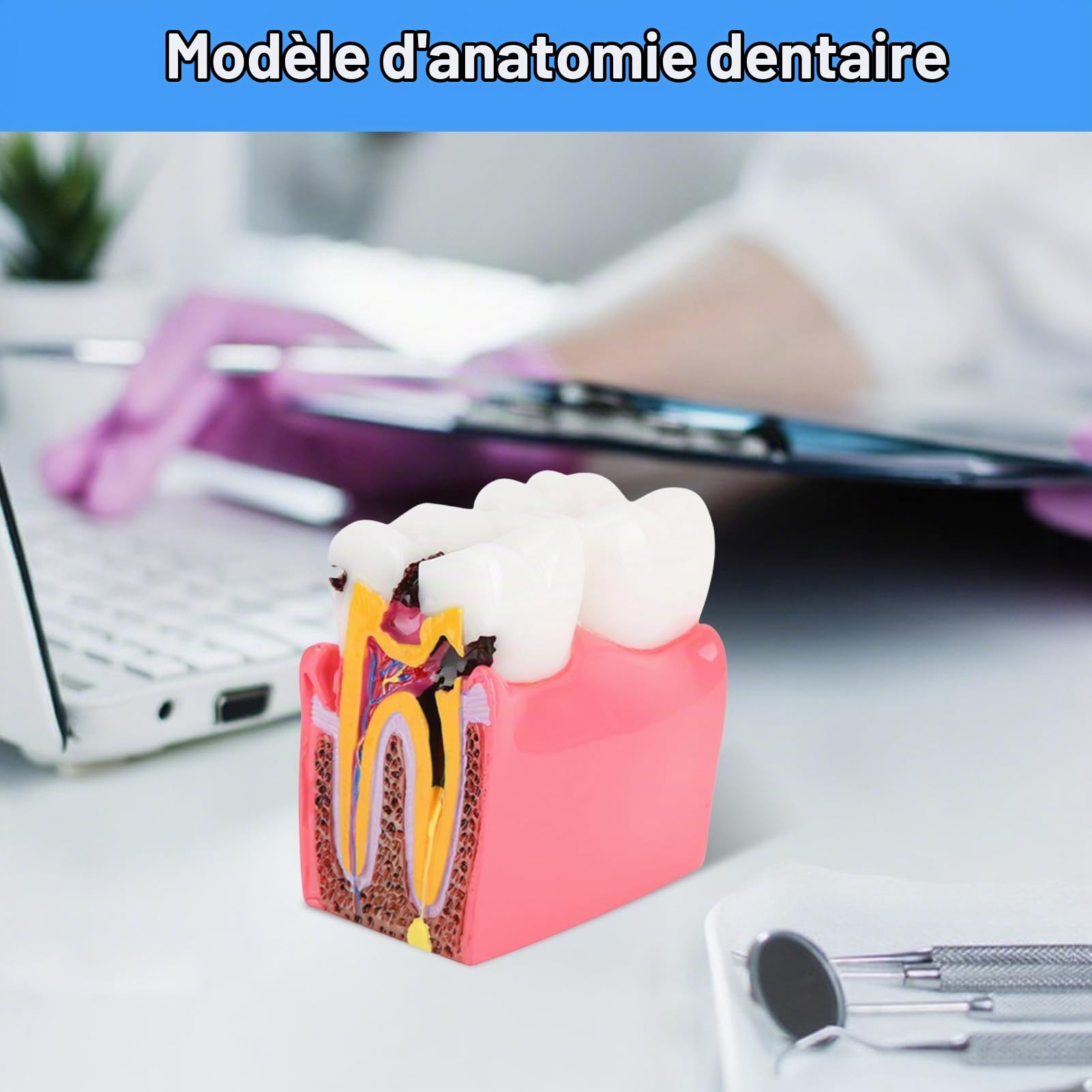 Agatige Modèle D'anatomie Dentaire, Modèles D'Étude De Comparaison De Caries Modèle De Dents D'Éducation À L'anatomie Dentaire De Dentiste Modèle De Développement De Caries Dentaires pour L'Éducation