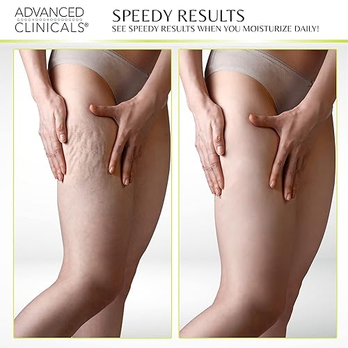 Miniatura 7 de Advanced Clinicals - Crema hidratante y adelgazante con grano de café verde, loción anticelulítica para piernas, brazos y cuerpo, crema reafirmante,