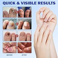 Vista 6 de Parches de uñas, parches de uñas de 42 piezas para uñas de los pies, parches de tratamiento de uñas extra fuertes, yesos de uñas extra fuertes de 8