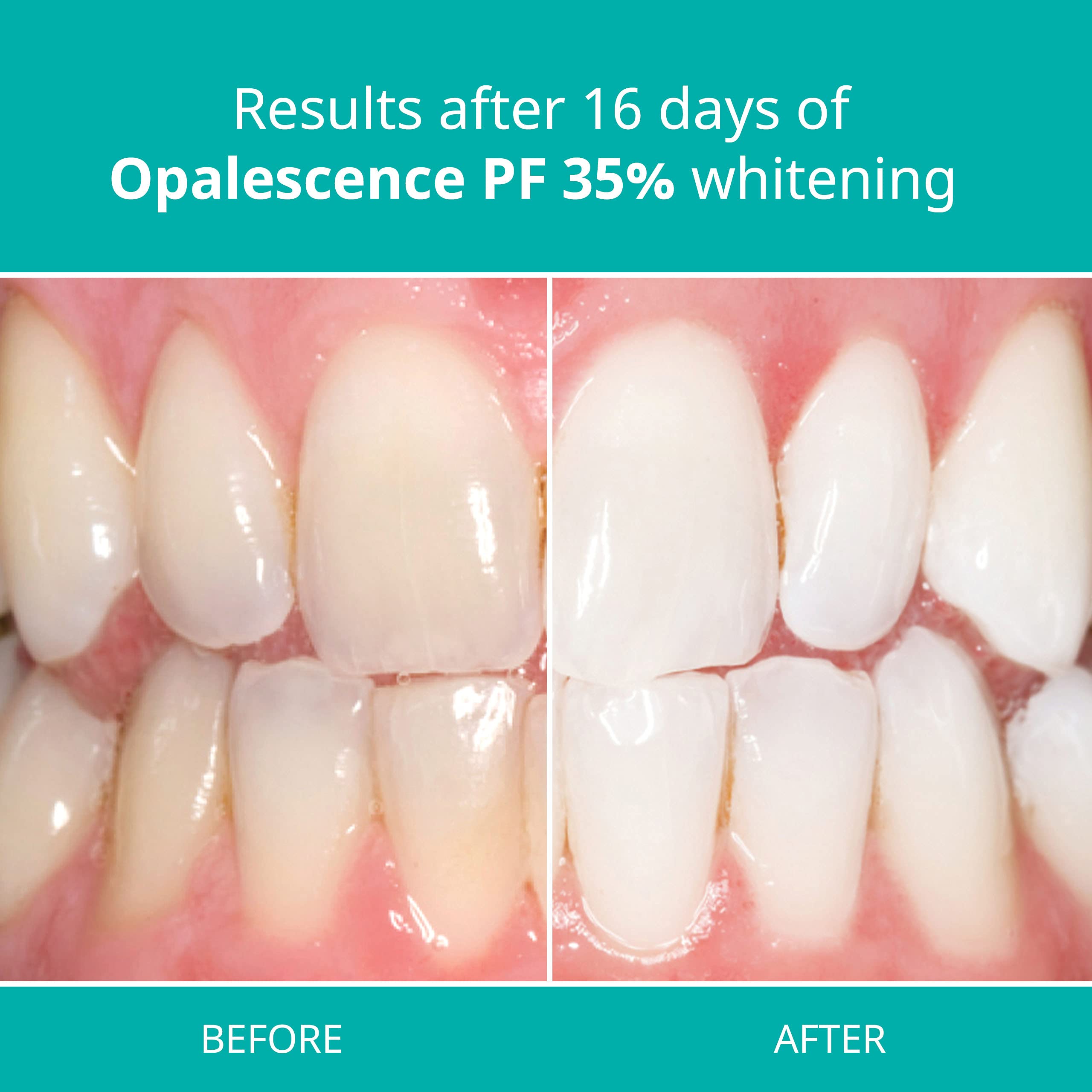 Opalescence PF Teeth Whitening Gel Syringes 35 Mint Teeth