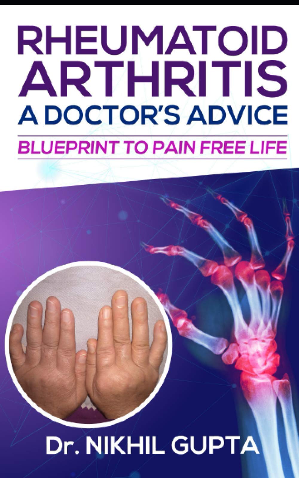 RHEUMATOID ARTHRITIS – A DOCTOR’s ADVICE: BLUEPRINT TO PAIN FREE LIFE