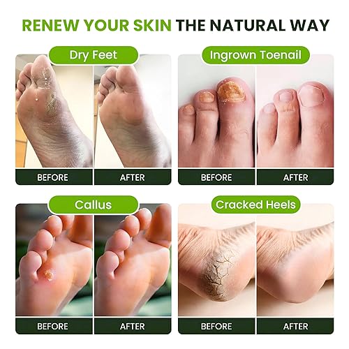 Miniatura 4 de FOOT CURE Aceite de árbol de té para pies con sal de Epsom – El mejor tratamiento para hongos en las uñas, pie de atleta y suaviza los callos