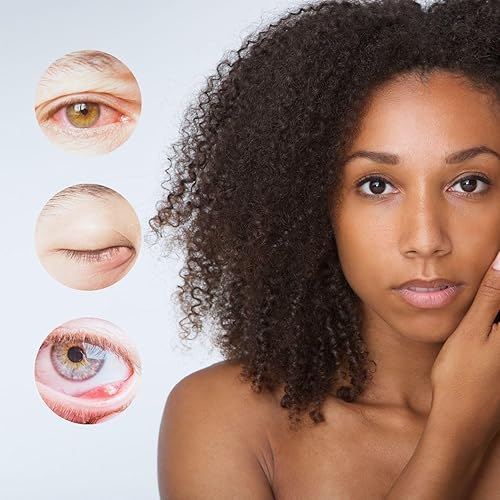 Miniatura 3 de brazzoMD Alivio de orzuelo formulado por médicos, ayuda a los calaziones, fabricado con árnica y caléndula de 1.0 onzas líquidas.