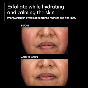 PCA SKIN Resurfacing Serum, Exfoliating Facial Corrective Serum, 1 oz
