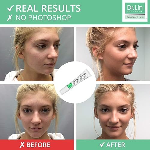 Miniatura 6 de Dr Lin Skincare Corrector de manchas de acné dirigido tratamiento de zit benzoilo peróxido 5 emergencia acné medicación cura manchas durante la