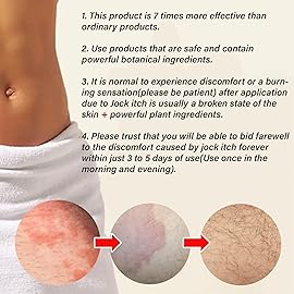 Jock Itch Cream: Extra Strength Jock Itch Treatment for Men and Women - Yeast Infection Treatment for Groin Inner Thighs - Yeast Infection Cream for Itchy Balls - Relief for Itchy Skin - 2.02 OZ