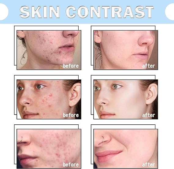 Deep Cleansing Lotion for Acne, Pimples and Acanthosis Nigricans, Acanthosis Nigricans Therapy Cream, Helps clear body pimples and spots, 100ml (2pcs)