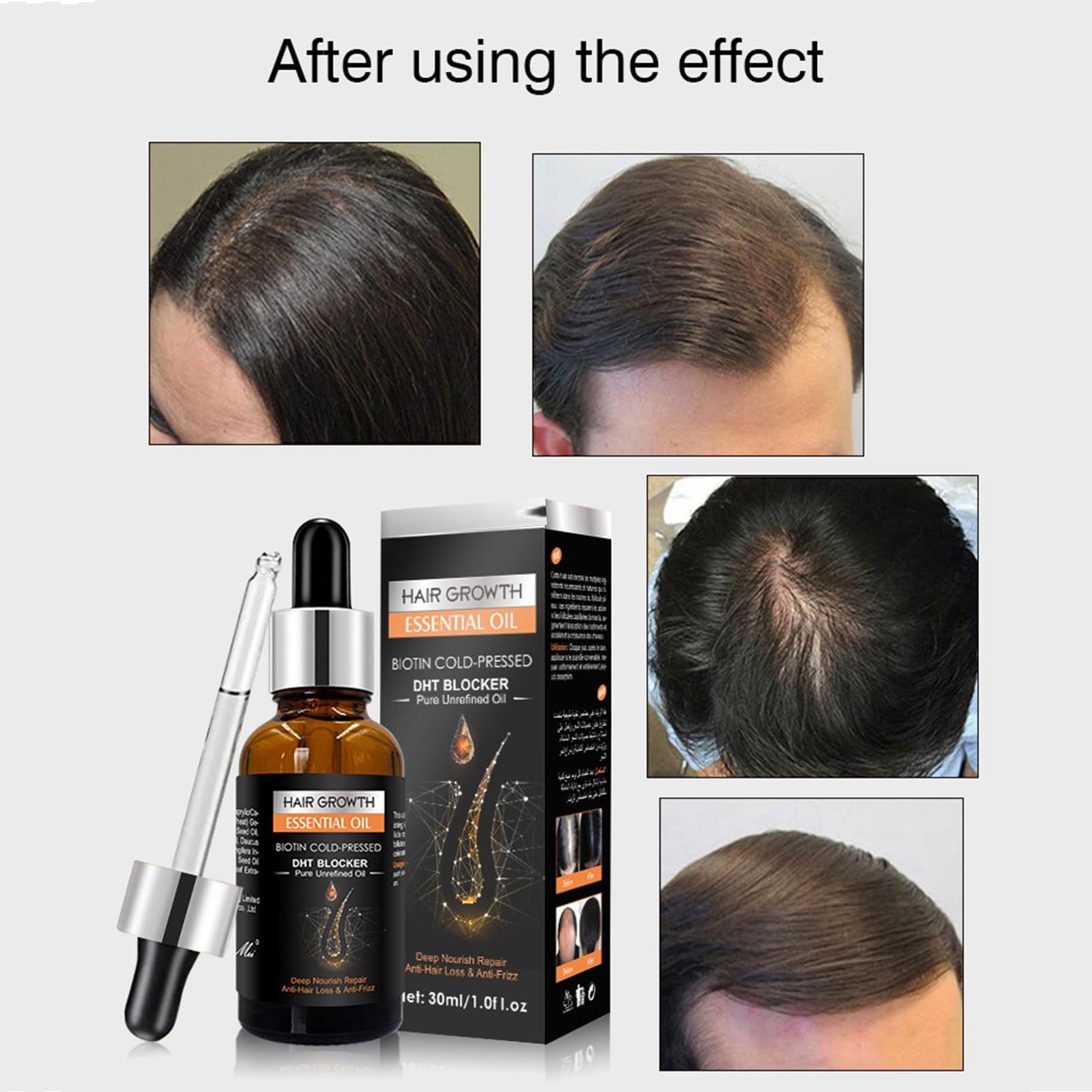 Serum na porost włosów Derma-roller 0,5mm, zestaw do wzrostu włosów z imbirem, walec do mikronigdlingu z serum do włosów, olejek z imbiru do wzrostu włosów, olejek do włosów na przyspieszenie wzrostu