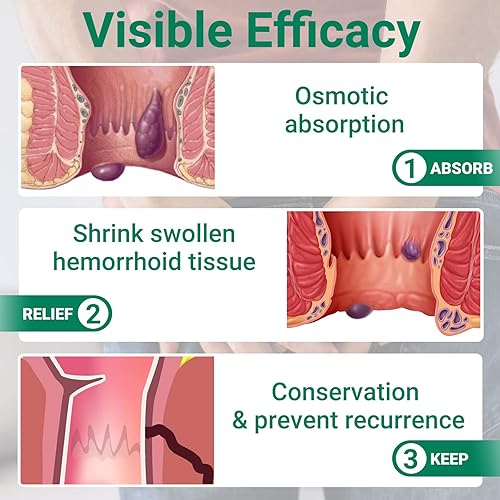Miniatura 6 de LMNOOP Ungüento para tratamiento de hemorroides, tratamiento de máxima fuerza y alivio rápido para el dolor, picazón, ardor, hinchazón, fisura,