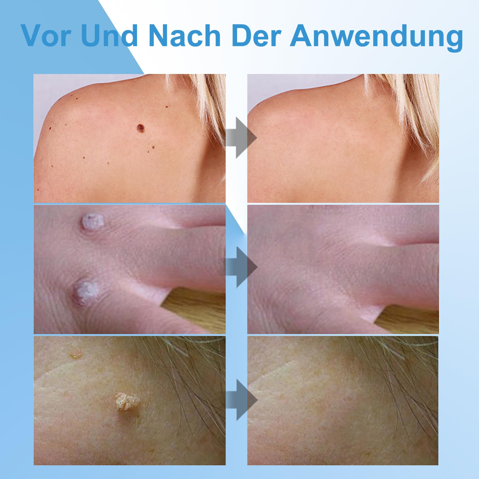 Warzenentfernungscreme für Gesicht und Körper - 20g