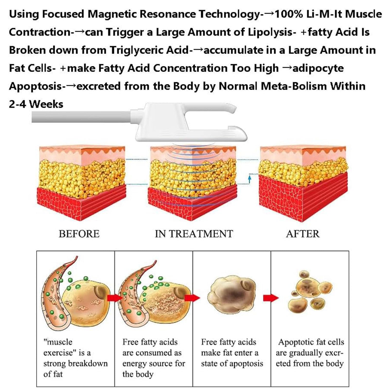 Macchina Professionale per Modellare Il Corpo E Sviluppare I Muscoli, Stimolatore Muscolare Magnetico Elettrico con RF per Addome, Braccia, Gambe E Glutei, Tonificatore Addominali WithoutRF