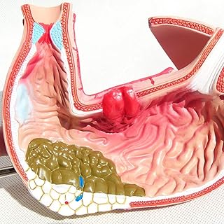 Stomach Anatomy Model - Gastritis Model Gastric Lesion Model-Gastric Diseases Demonstration Human Digestive System Médical Teaching Anatomical Model