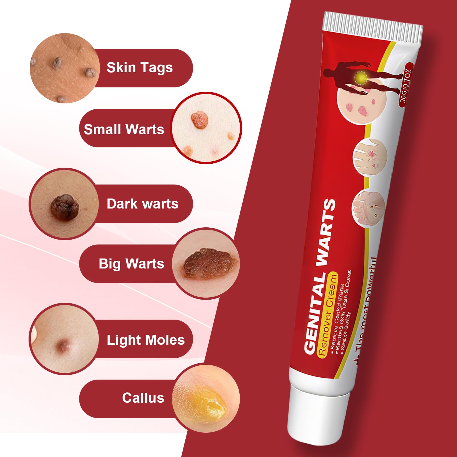 20g Eliminador De La Piel Verrugas Crema, Eliminación las Verrugas en los pies, Manos y Cuerpo, Atención Diaria, Adecuado para Partes del cuerpo