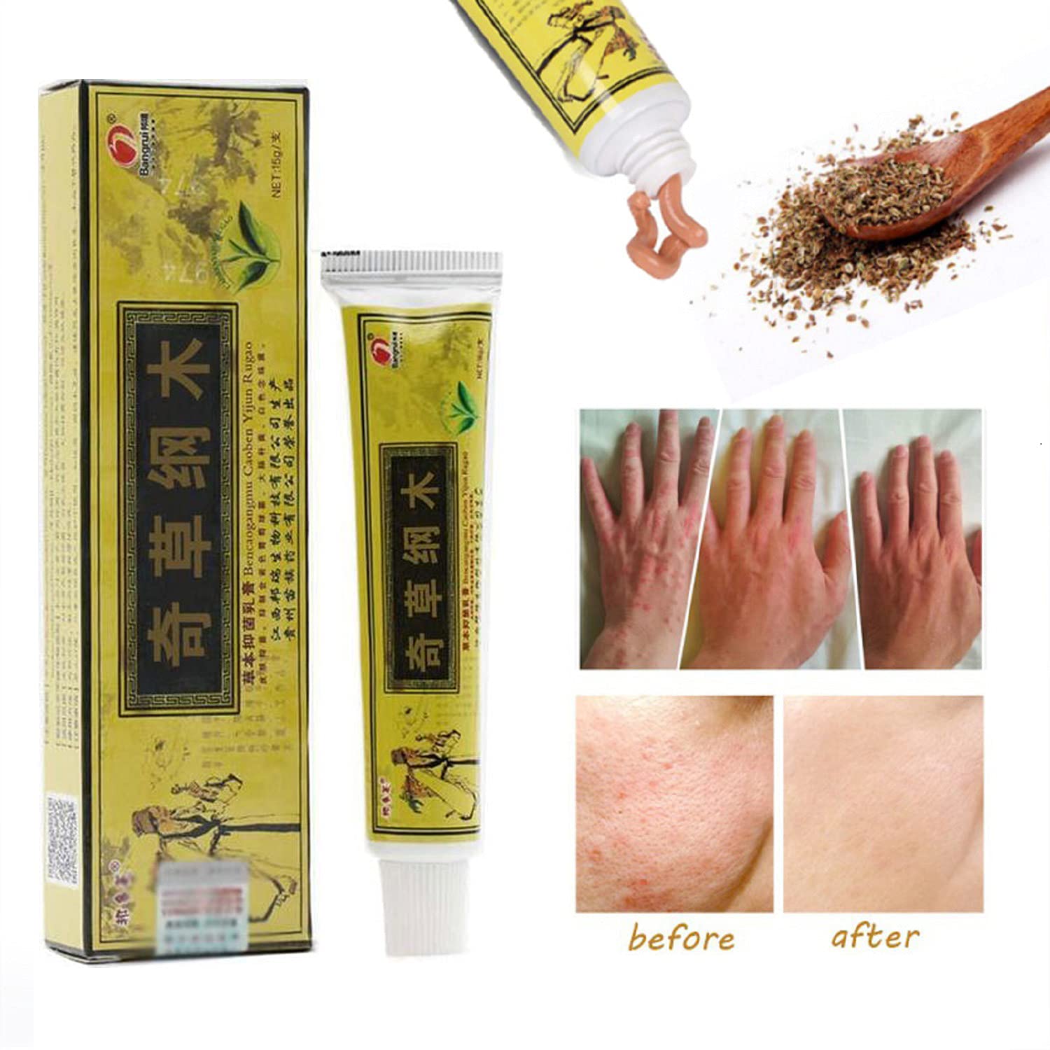 5 Pcs Lot Chinese Herbal Eczema, Psoriasis Creams Dermatitis and Eczema