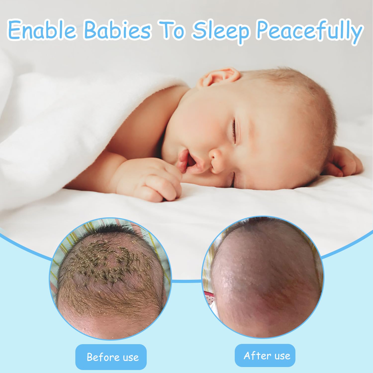 2 PCS Peigne pour Croûtes de lait, Brosse de Bain pour Bébé, Peigne pour Enfants, Arc de Forme Brosse à Cheveux, Aide à Masser Doucement le Cuir Chevelu?Baleine bleue?