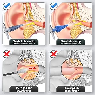 Ear Wax Removal, Ear Cleaner, Ear Cleaning Kit, Manual Ear Irrigation Flushing System, Ear Wax Removal Kit, Safe and Effective to Clean Ear Built Up Wax