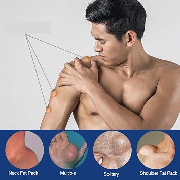 Lipoma Removal Cream,Anti-cellulite Body Shaper Spray for Men and Women,20g