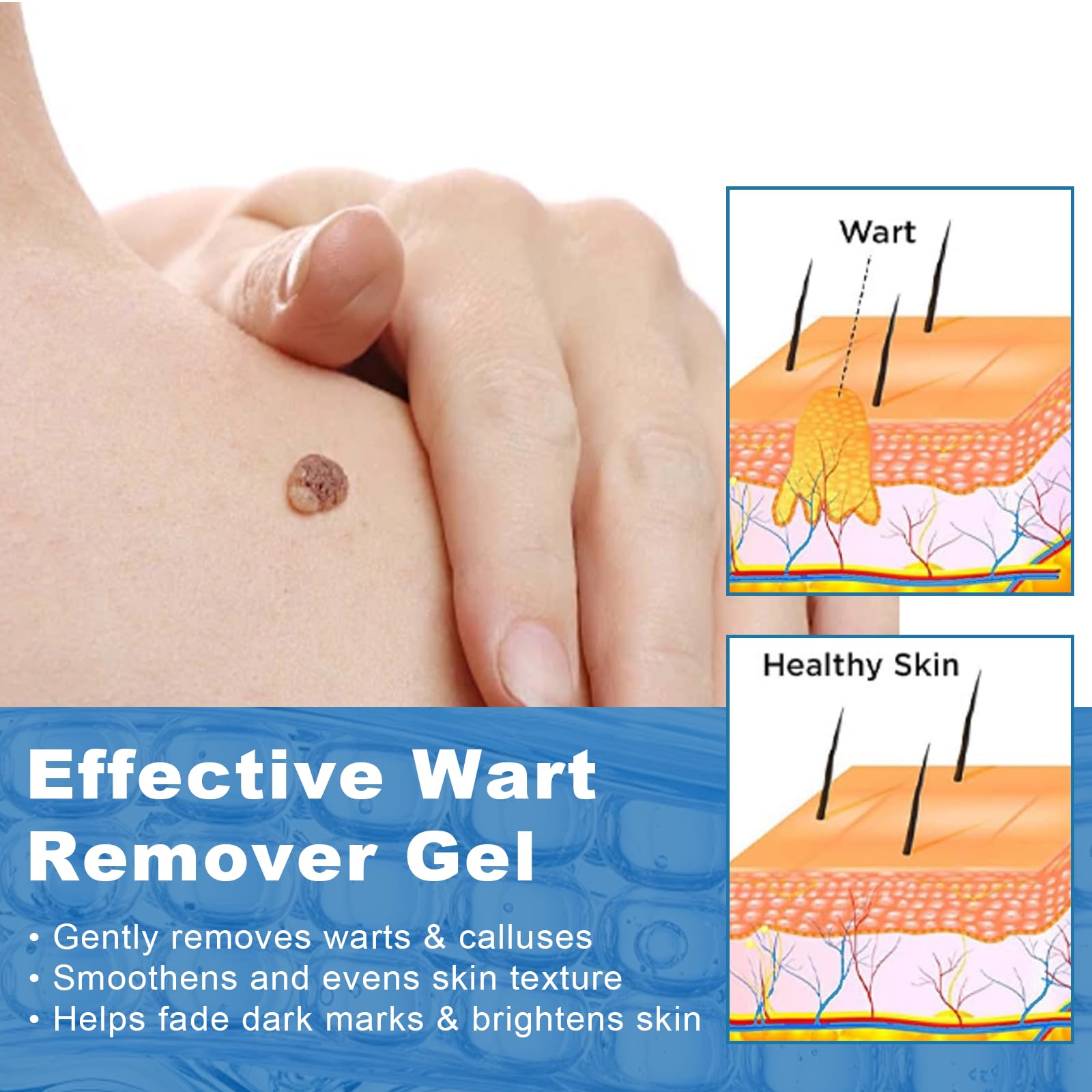 Gel para eliminar verrugas 20g - Aplicación precisa, adecuado para eliminar verrugas en el cuerpo y las manos, apto para todo tipo de piel