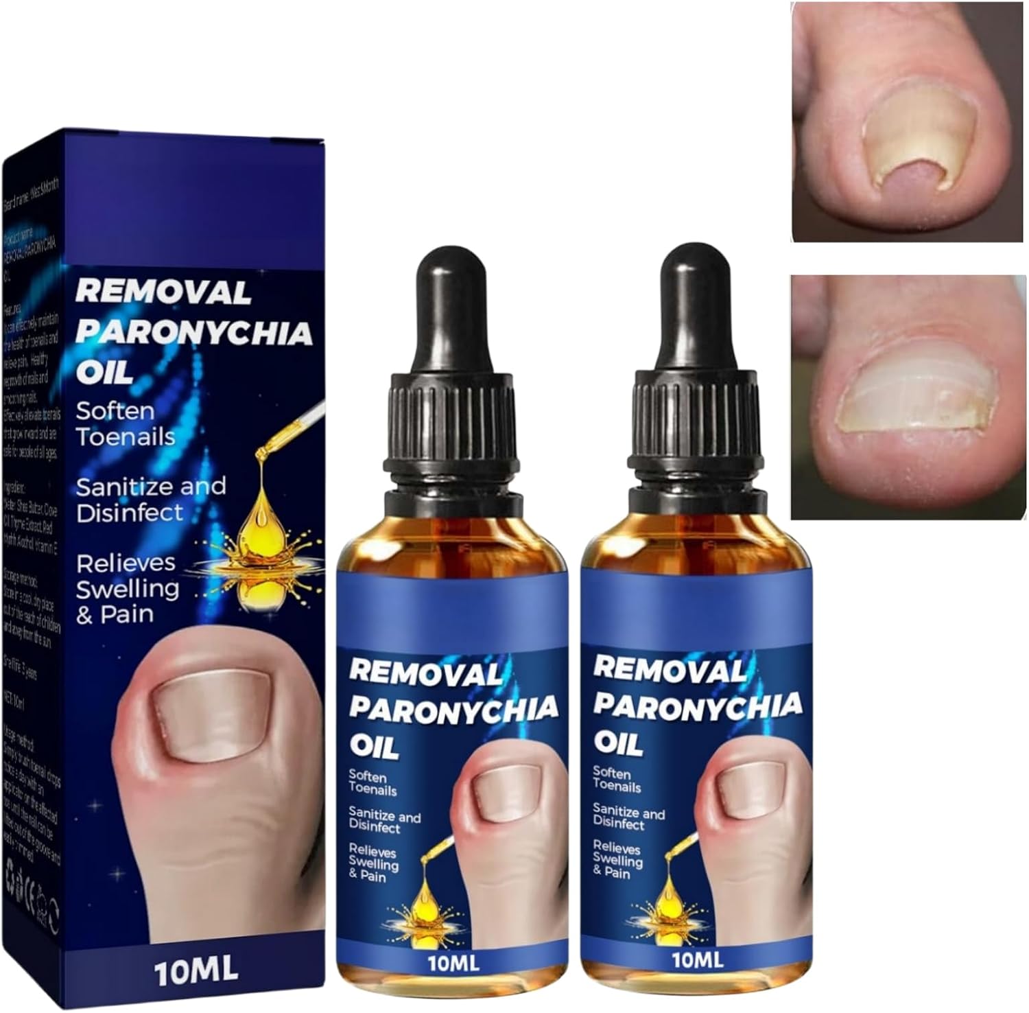 2PCStreatment for Ingrown Toenail,Ingrowing Toenail Treatment,Ingrown Toenail Treatment,Fungal