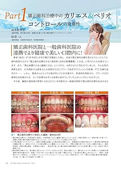 デンタルハイジーン 矯正治療中の患者さんのカリエス&ペリオ