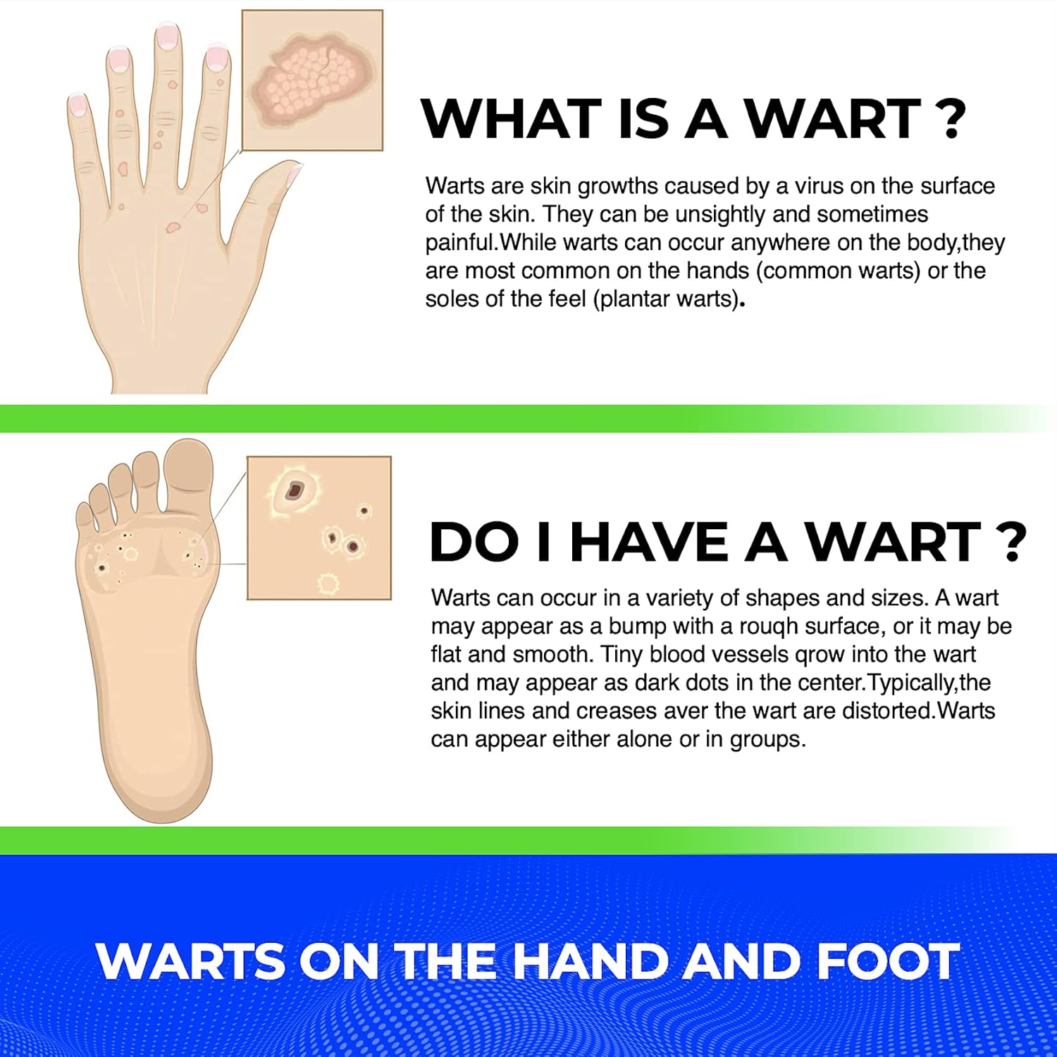 ACCBTECH Liquid Wart Remover - Advanced Wart Treatment Lotion for All Warts Types Including Common and Genital - Painless and Fast-Acting (10ml)