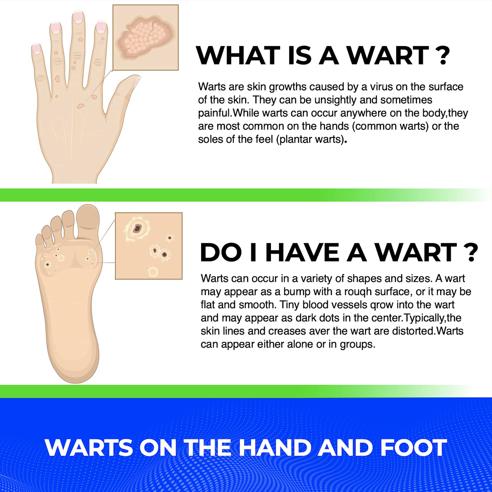 Buy Wart Remover Liquid Rapidly Eliminates Both Plantar and Common