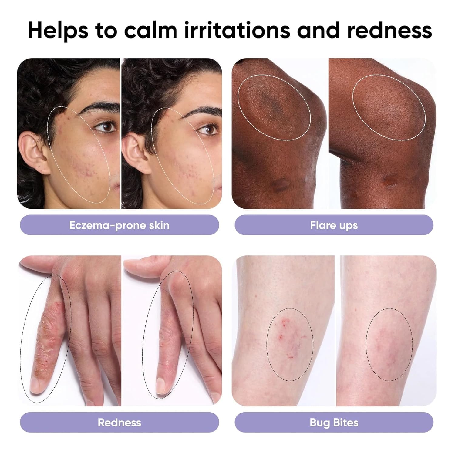 Itch Relief Spray – High Purity Hypochlorous Acid Spray, Fast Anti Itch Relief from Bug Bites, Rashes, Scrapes, Burns, and Helps Provide Relief from Eczema, Steroid & Alcohol-Free (3.4oz) - image 3