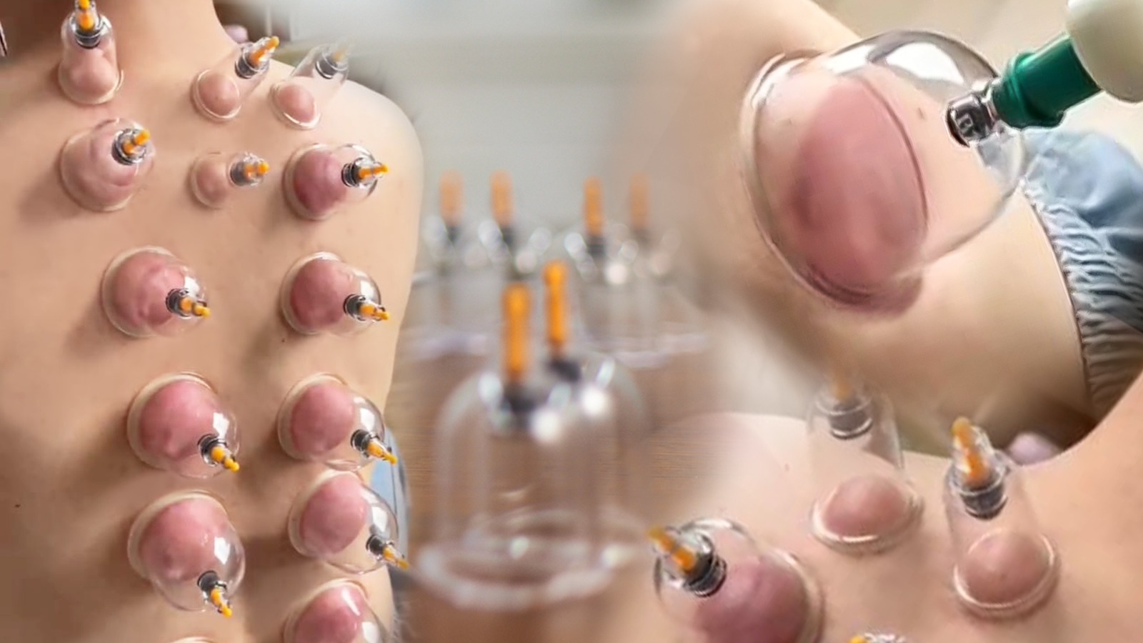 Amazon.com: [100 Pack] Bulk Cupping Set for Massage Therapy - B1