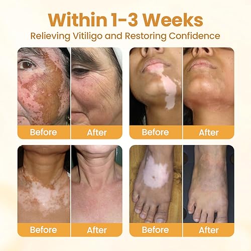 Miniatura 2 de Timilk VitiCalm - Crema de veneno de abeja, crema de vitíligo profesional, tratamiento natural de vitíligo, reduce las manchas blancas y mejora la