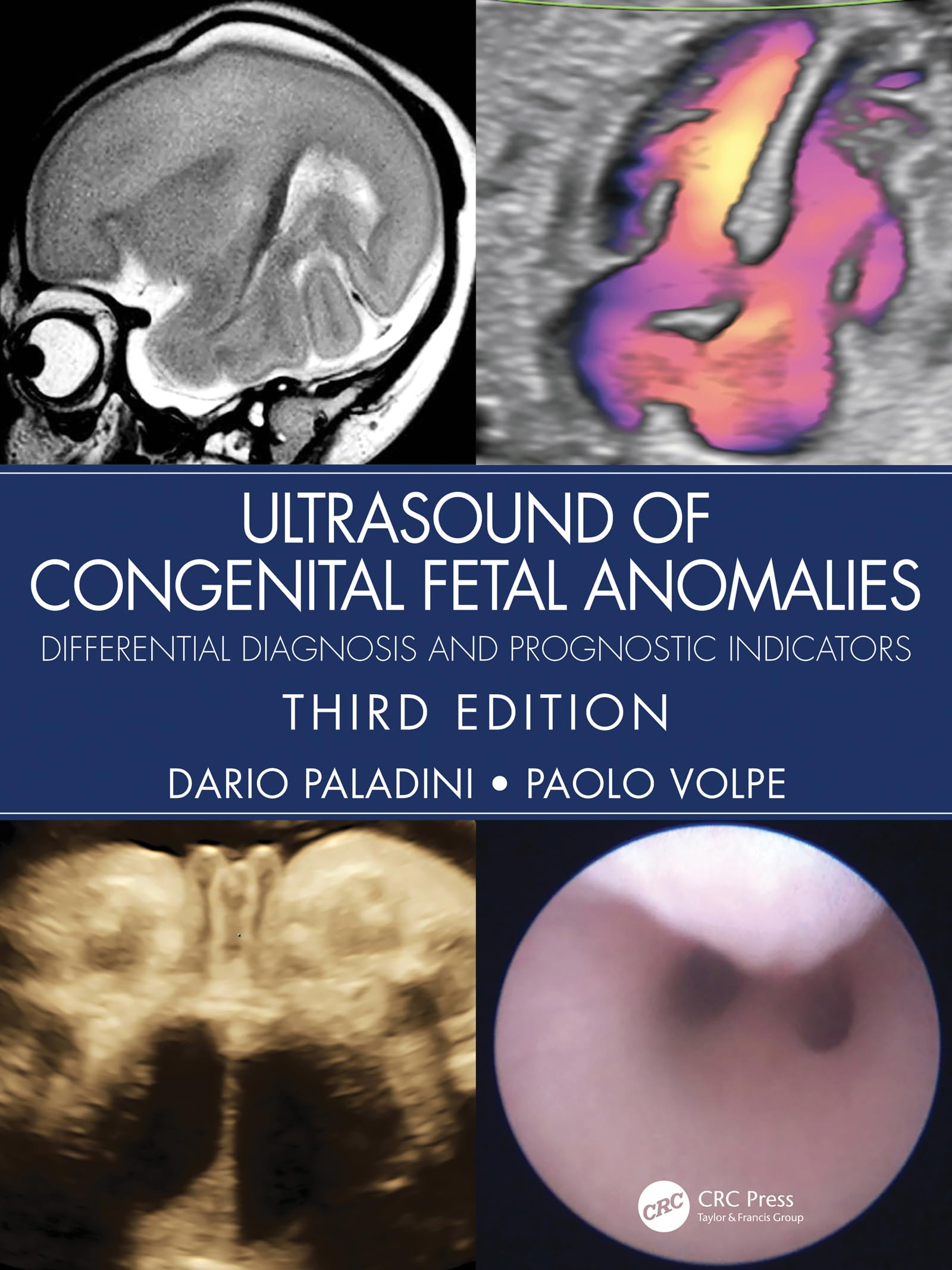 Ultrasound of Congenital Fetal Anomalies: Differential Diagnosis and Prognostic Indicators (English Edition)