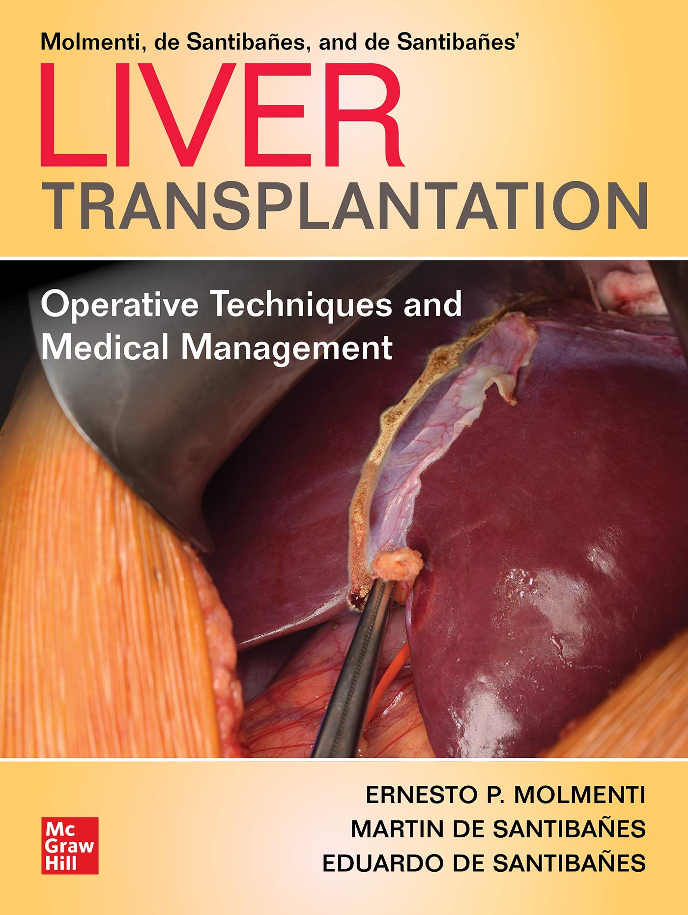 Liver Transplantation: Operative Techniques and Medical Management (English Edition)