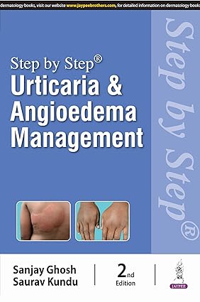 STEP BY STEP URTICARIA AND ANGIOEDEMA MANAGEMENT