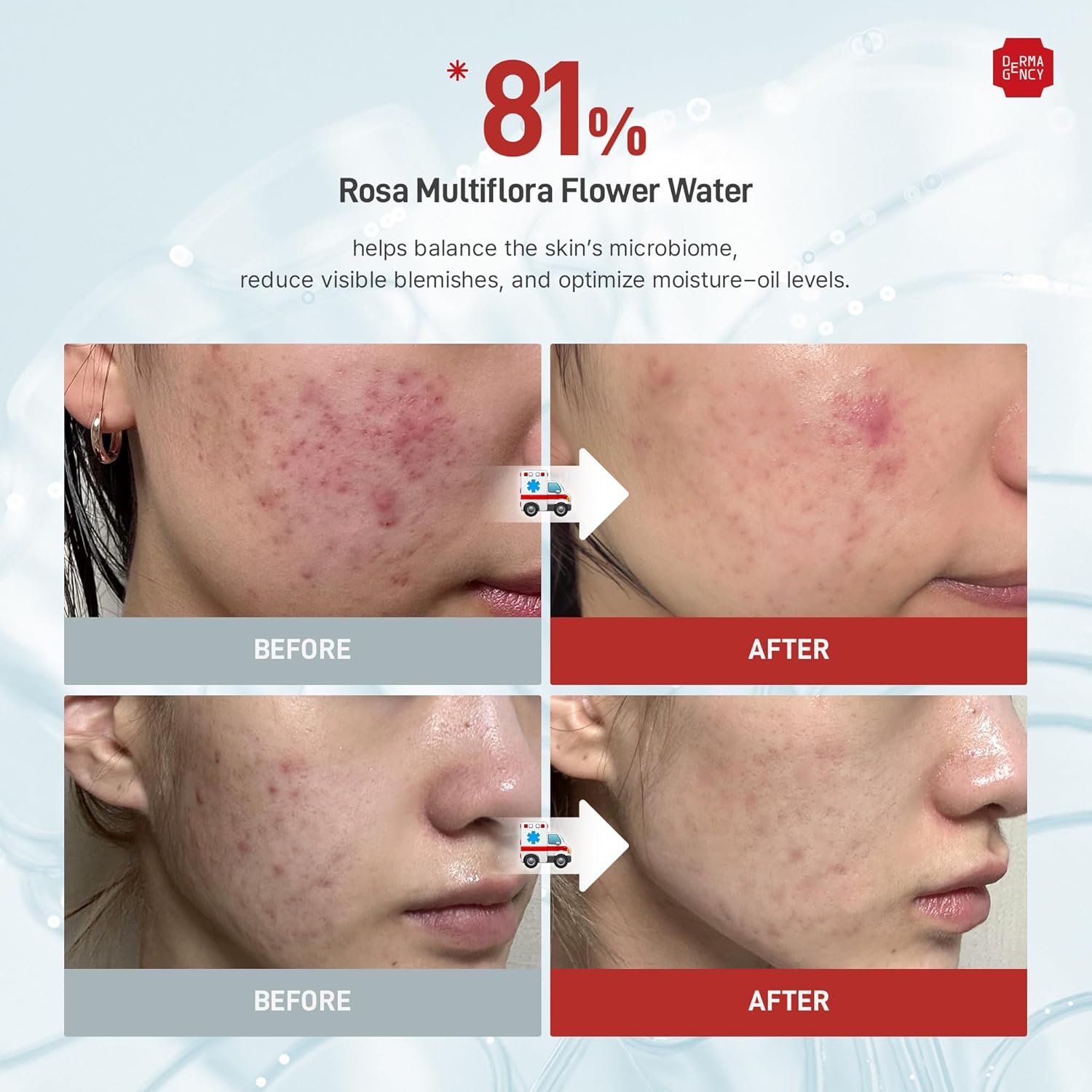 Zeroca 81 Cream – Korean Wild Rose Moisturizer for Acne-Prone & Sensitive Skin, Controls Sebum, Lightweight Hydration for Smooth Texture | 60ml/ 2.02oz