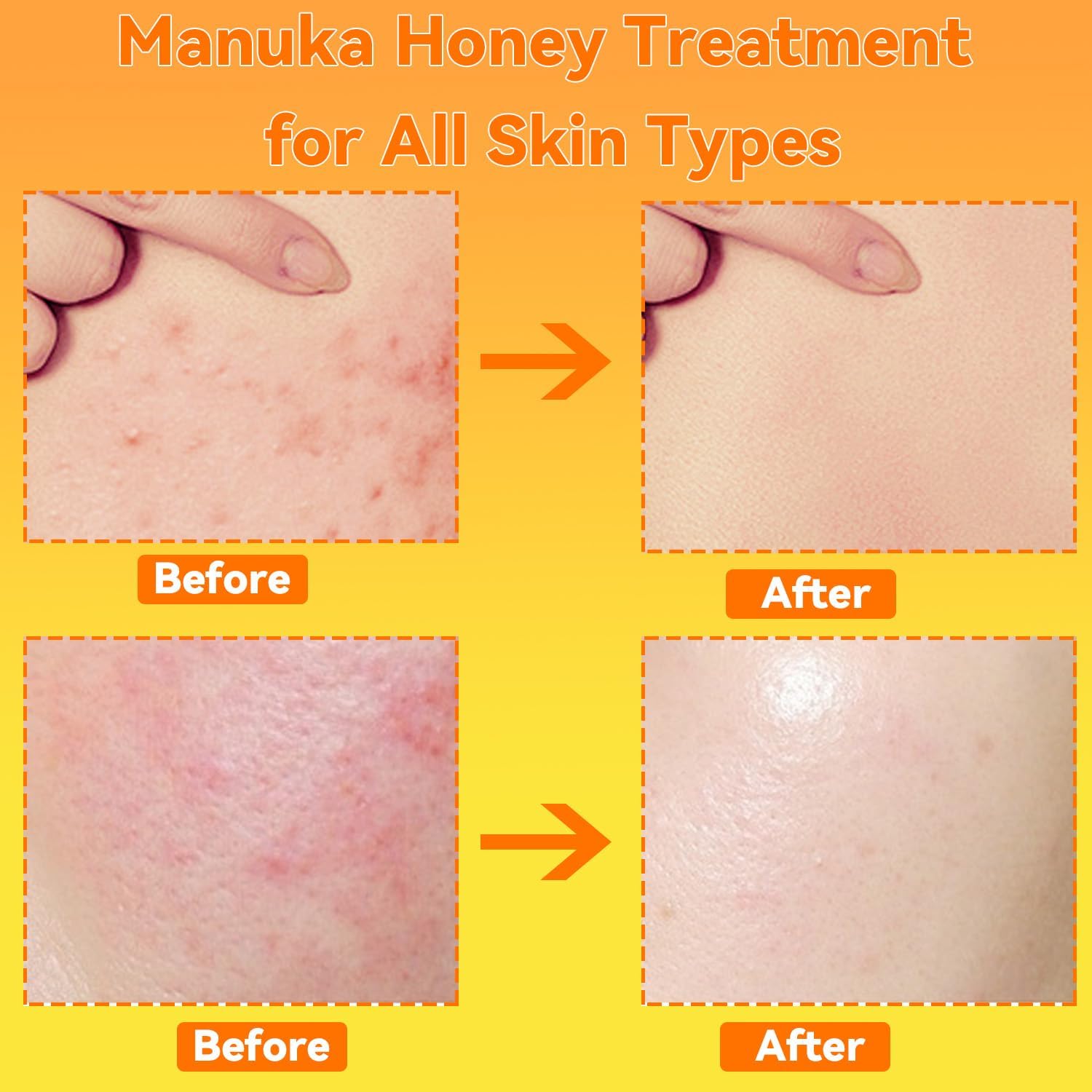 Manuka Honey Cream Max Strength Treat Natural Organic Ointment, Soothing Relief for Itching, Eczema, Psoriasis,Dry, Heat Rash, Leg, Stomach, Armpit, Foot, Hand