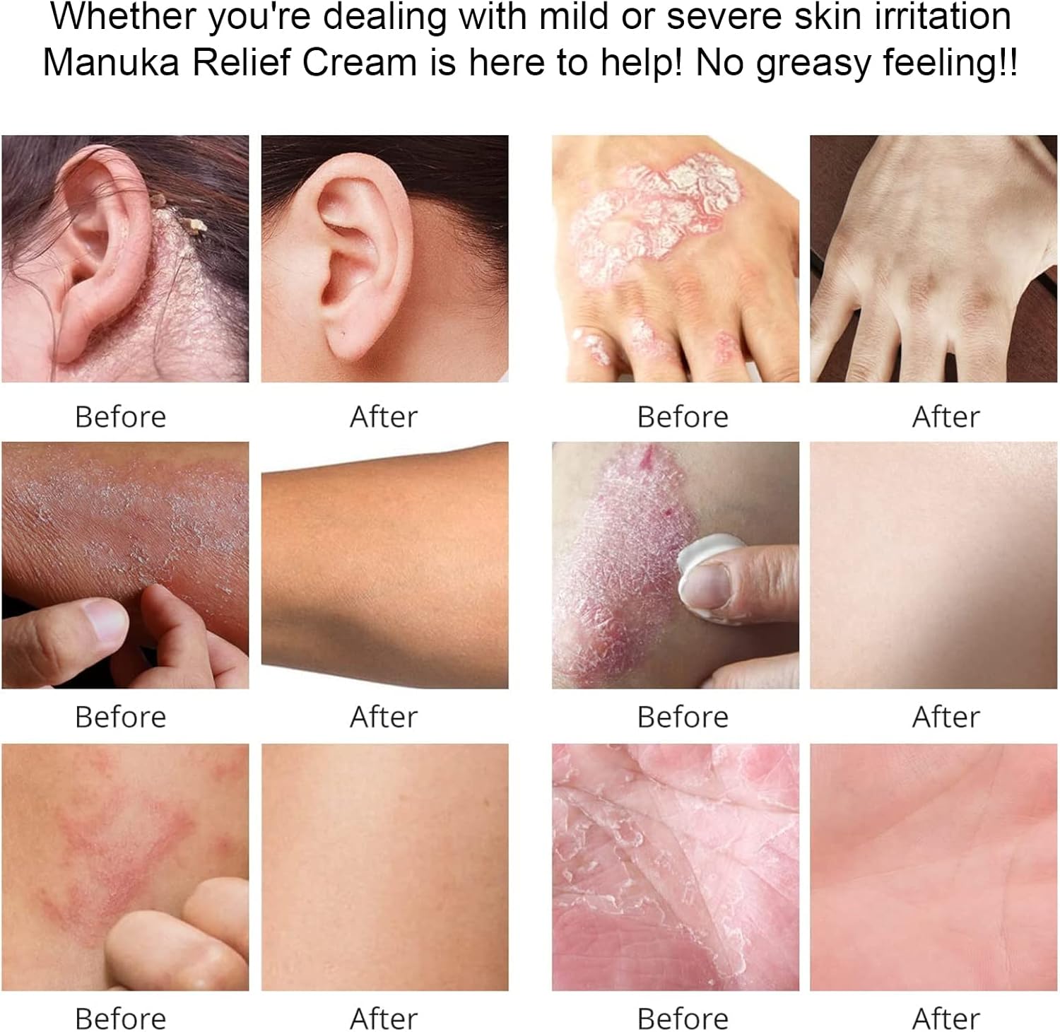Max Strength Treat Organic Manuka Honey Lotion Cream - Soothing Moisturizer for Dry Skin, Treat for Relief - Hand & Body Eczema, Psoriasis, Itch, Gentle Plant Non-Irritating For Adults, Kids, Baby