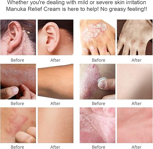 Miniatura 6 de Crema orgánica de loción de miel de manuka con avena coloidal, hidratante calmante para piel seca, tratamiento para alivio, eccema de manos y